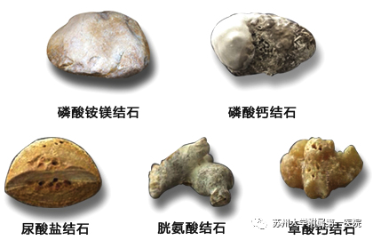 依据化学成分的不同,结石大致可分为五类:草酸钙类结石,磷酸钙类结石
